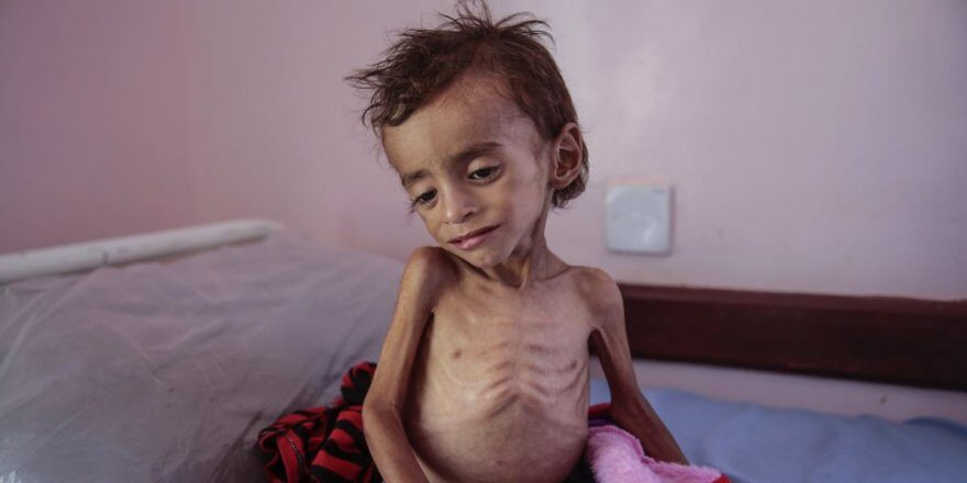 Yemen’de açlık nedeniyle 100 bin çocuk ölümün eşiğinde