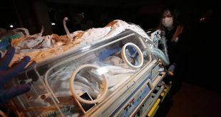 Suriye'li siyam ikizleri tedavi için Ankara'da