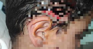 8 köpeğin saldırısına uğrayan çocuğa 80 dikiş atıldı