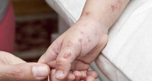 Maymun çiçeği virüsüne karşı uyarı: Mesafe ve temasa dikkat!