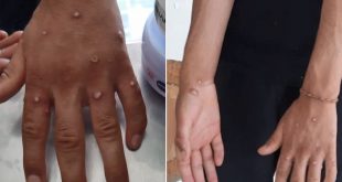 İstanbul'da maymun çiçeği şüphesi!