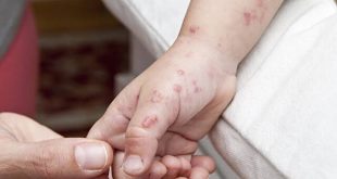 Maymun çiçeği virüsü o ülkeye de sıçradı