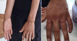 Maymun çiçeğinden şüphe edilen 4 kişinin test sonuçları belli oldu