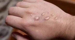 Sınır komşumuzda ilk maymun çiçeği vakası