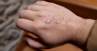 Gana'da maymun çiçeği 4 can aldı