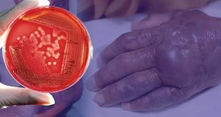 İnsan eti yiyen bakteri ABD'de yayılıyor!