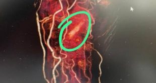 Kadın hastanın eli içinde odun parçası unutuldu