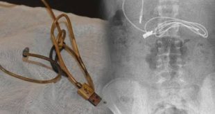 15 yaşındaki gencin midesinden çıkanlar yok artık dedirtti!