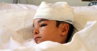 Sokak köpeği dehşeti bitmiyor! Saldırdığı çocuğun saç derisini koparttı