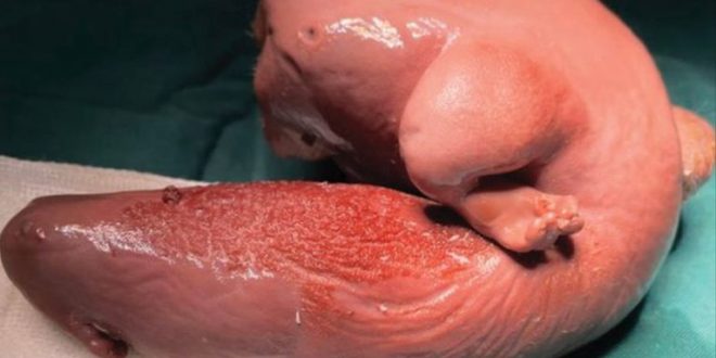 Çin'de bebeğin beyninden doğmamış ikizi çıkarıldı