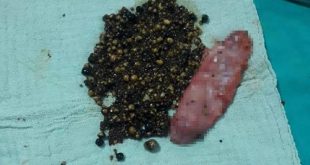 20 yıldır ameliyatı erteledi, safra kesesinden 2 bin adet taş çıkarıldı!