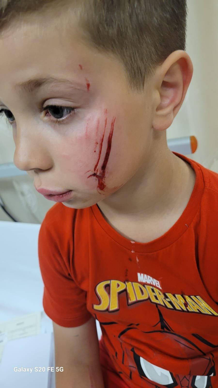 Bir başıboş sokak köpeği saldırısı daha! Küçük çocuğun yüzünü parçaladı