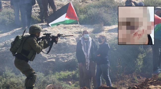 İsrail’de zulüm üstüne zulüm: Filistinli gencin yüzüne ‘Davud Yıldızı’ kazıdılar