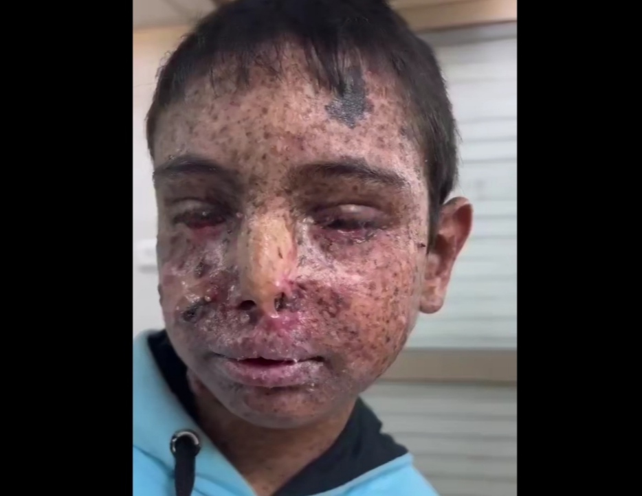 İsrail’in kimyasal silahları çocukları diri diri yakıyor!