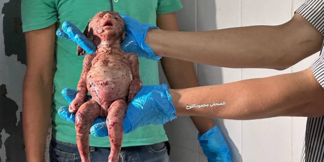 Kör olan görsün, sağır olan duysun! Anne karnında şehit oldu