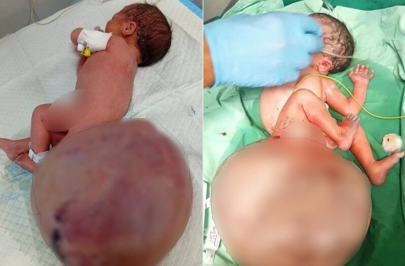 Doğmadan kimyasala maruz kaldılar: Gazze’de tümörlü doğan bebekler!