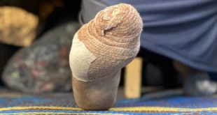 gaza rodnet injury mee 2026.jpg