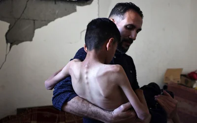 palestine gaza malnutrition bureij april 2025 eyad baba afp.jpg